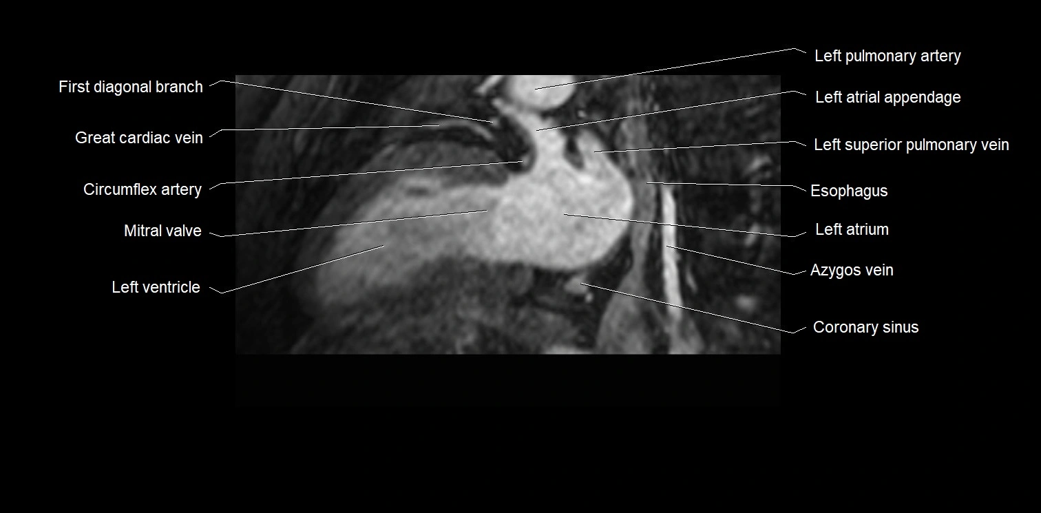 MRI heart and coronary arteries two chamber(sagittal)  anatomy image 27.webp